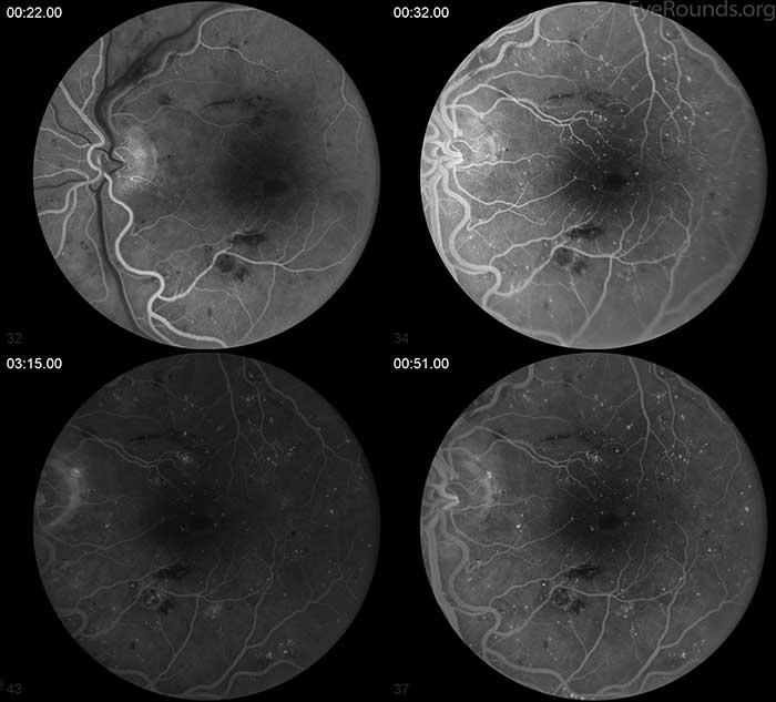 There is a similar appearance to the right eye with peri-foveal staining and diffuse punctate hyperfluorescence. Prominent blockage of fluorescein staining is seen due to flame hemorrhages in the inner retina.
