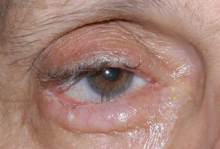 inward rotation of the lower eyelid margin with misdirected eyelashes abrading the cornea centrally