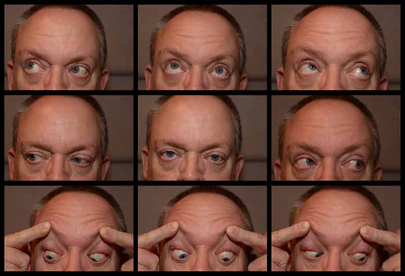 trochlear nerve palsy eye position