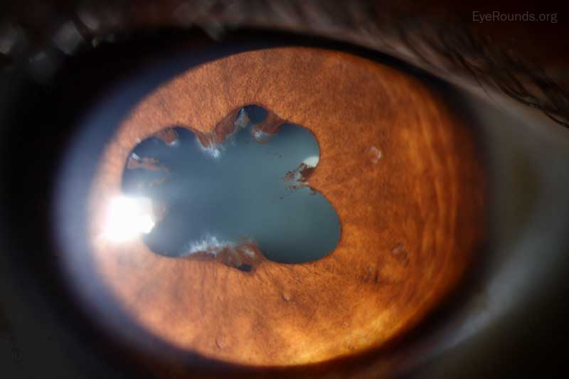 Patches of central posterior synechiae for 360 degrees around the pupillary margin of the left eye