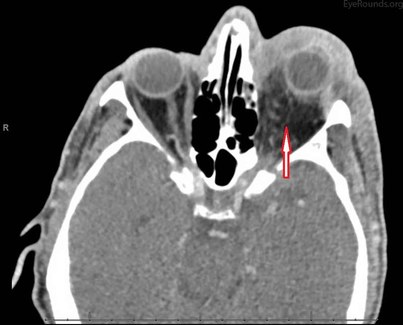 CT scan showing a 1.4 x 0.9 cm left parietal cutaneous fluid collection. Left pre and post septal orbital cellulitis with involvement of the superior rectus muscle.