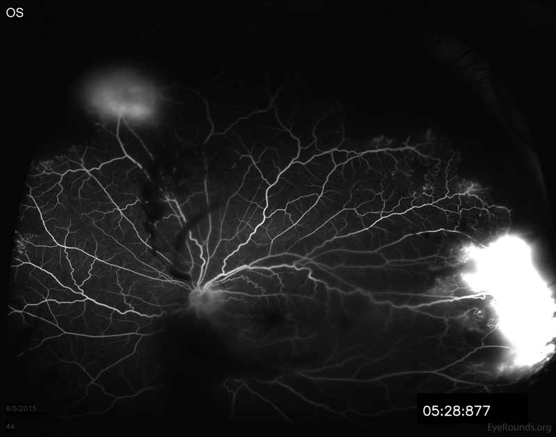 Fluorescein angiogram of the left eye showing hypofluorescence over the disc and macula from overlying vitreous hemorrhage. Note the late leakage from NVE in the superior retina. There is also marked late leakage inferotemporally associated with the NVE and a tractional membrane with adjacent peripheral capillary non-perfusion is visible in the nasal and temporal periphery. 