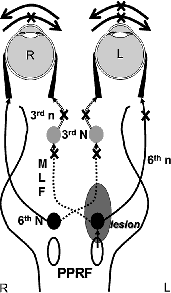 A schematic explanation of one-and-a-half syndrome. A lesion (gray) is shown affecting the left PPRF and left abducens nucleus causing an ipsilateral complete conjugate horizontal gaze palsy (note that only one of these structures must be involved, not both) and affecting the left MLF causing an ipsilateral INO. Only contralateral abduction is spared.