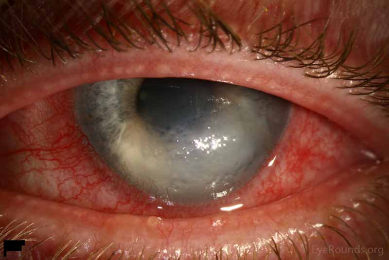 Figure 1a: Broad illumination of the left eye showing severe, inferior corneal edema.