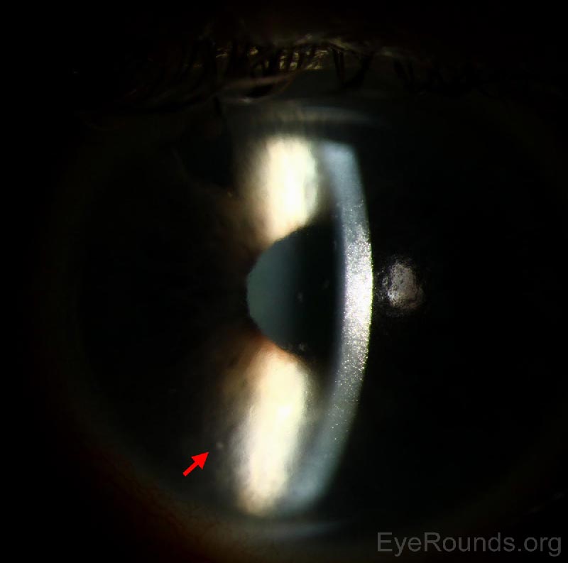 Slit lamp photograph of the left eye reveals a faint, small KP visible on the corneal endothelium (arrow).