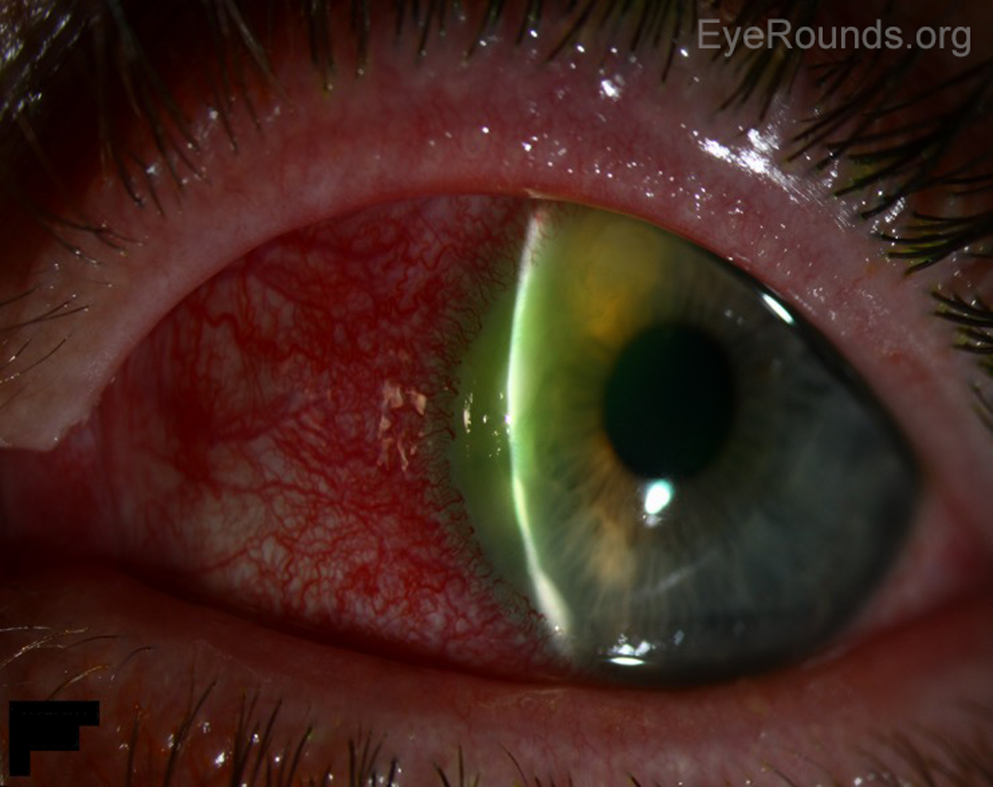 Corneal Marginal Ulcer