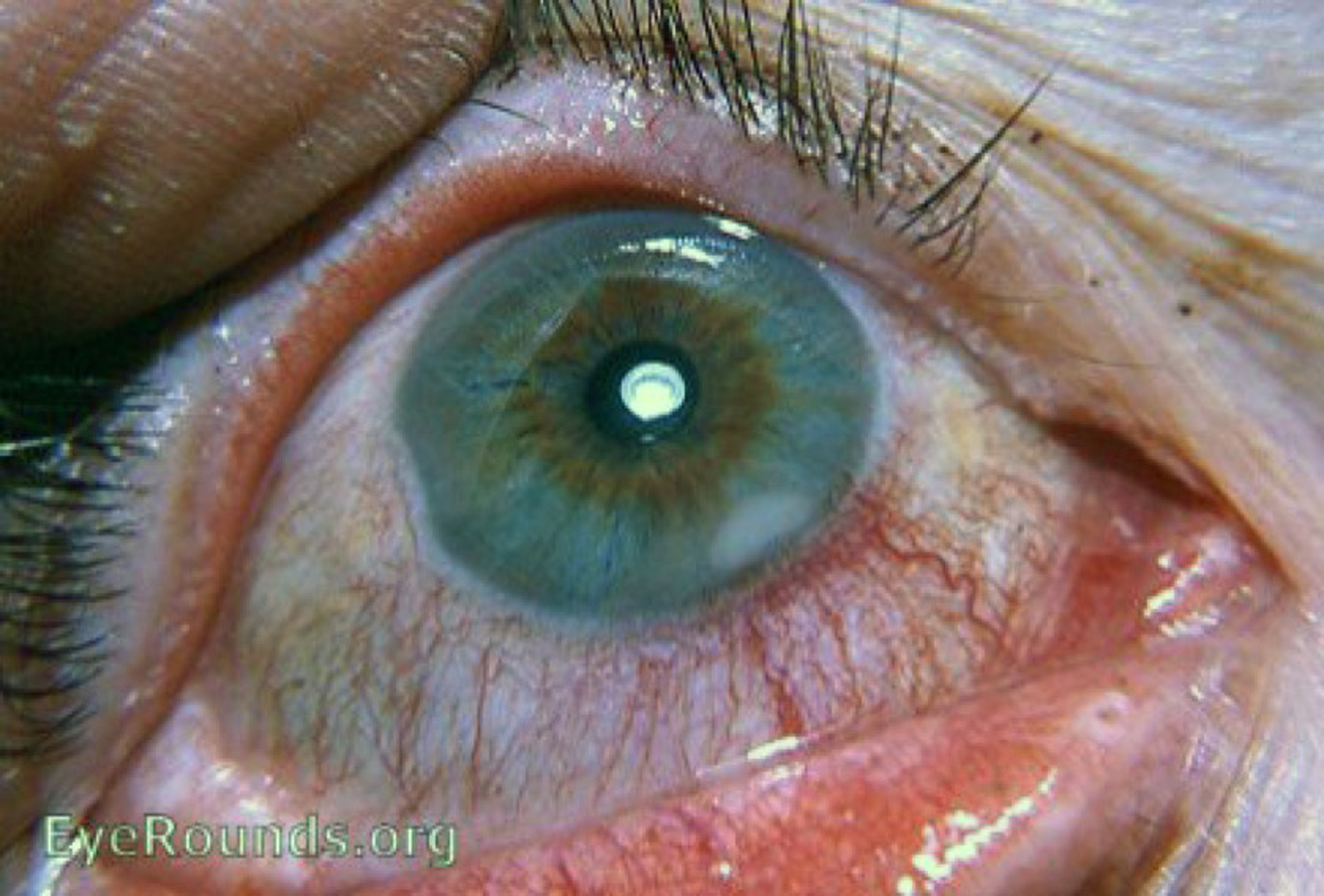 staphylococcal marginal keratitis