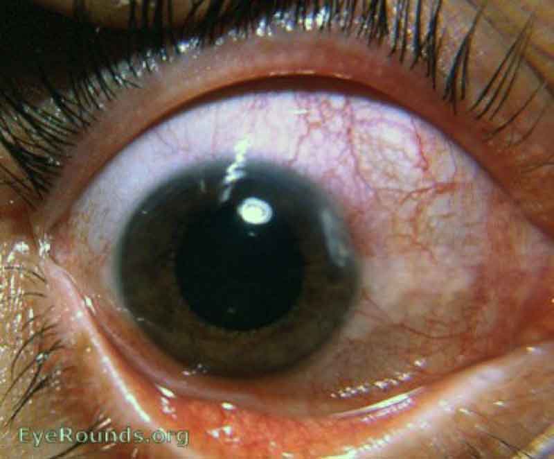 Marginal Keratitis with Rosacea. The corneal infiltrates seen in these photographs are active as evident by the hyperemia adjacent to the corresponding limbal area and the slit-lamp findings of an active keratitis.