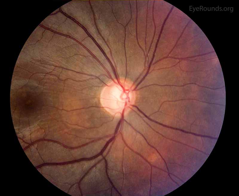 Figure 2:  Color fundus photo of the right eye, centered over the optic nerve head. In this photo, the optic nerve appearance is consistent with glaucoma as the cup to disc ratio is increased due to loss of the nerve tissue. The supporting history and other studies support these changes as attributable to glaucoma as compared to other etiologies of enlarged cup to disc ratio.