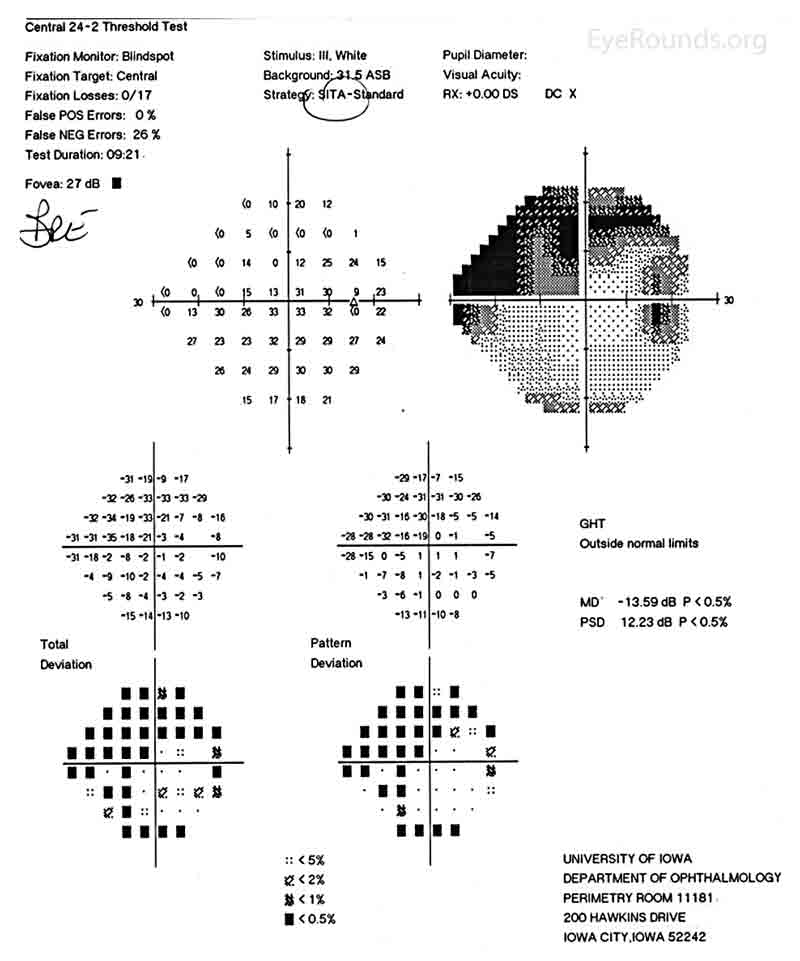 Figure 1: Humphrey Visual Field (HVF) of the right eye. This is a 24-2 visual field commonly used in the screening and monitoring of glaucoma patients. This patient's visual field represents severe stage glaucoma. There are both inferior and superior field defects and these defects approach central vision.