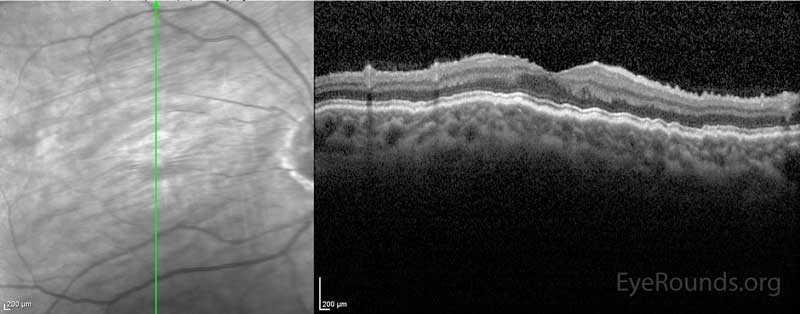 Figure 4: OCT showing hypotony maculopathy. There is a wrinkled appearance to all of the chorioretinal layers.