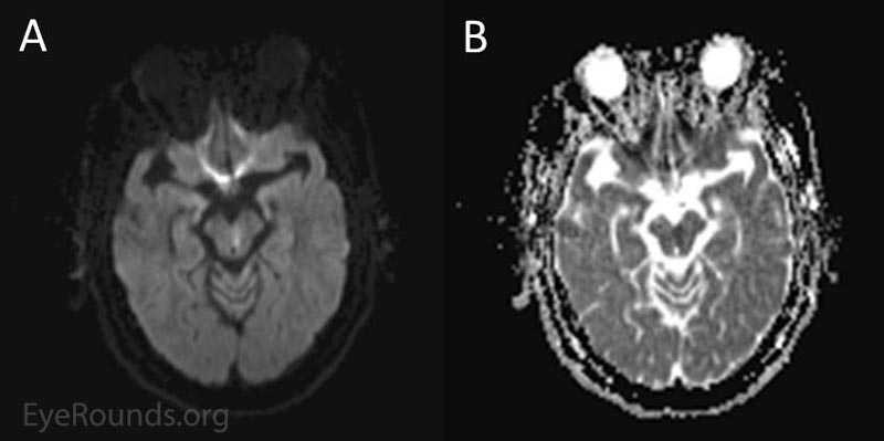 Figure 1. MRI findings. Note the area of diffusion restriction (hyperintensity on DWI images) in image A with a corresponding area of hypointensity on apparent diffusion coefficient (ADC) images as seen in image B along the left inferior midbrain, just anterior to the cerebral aqueduct.