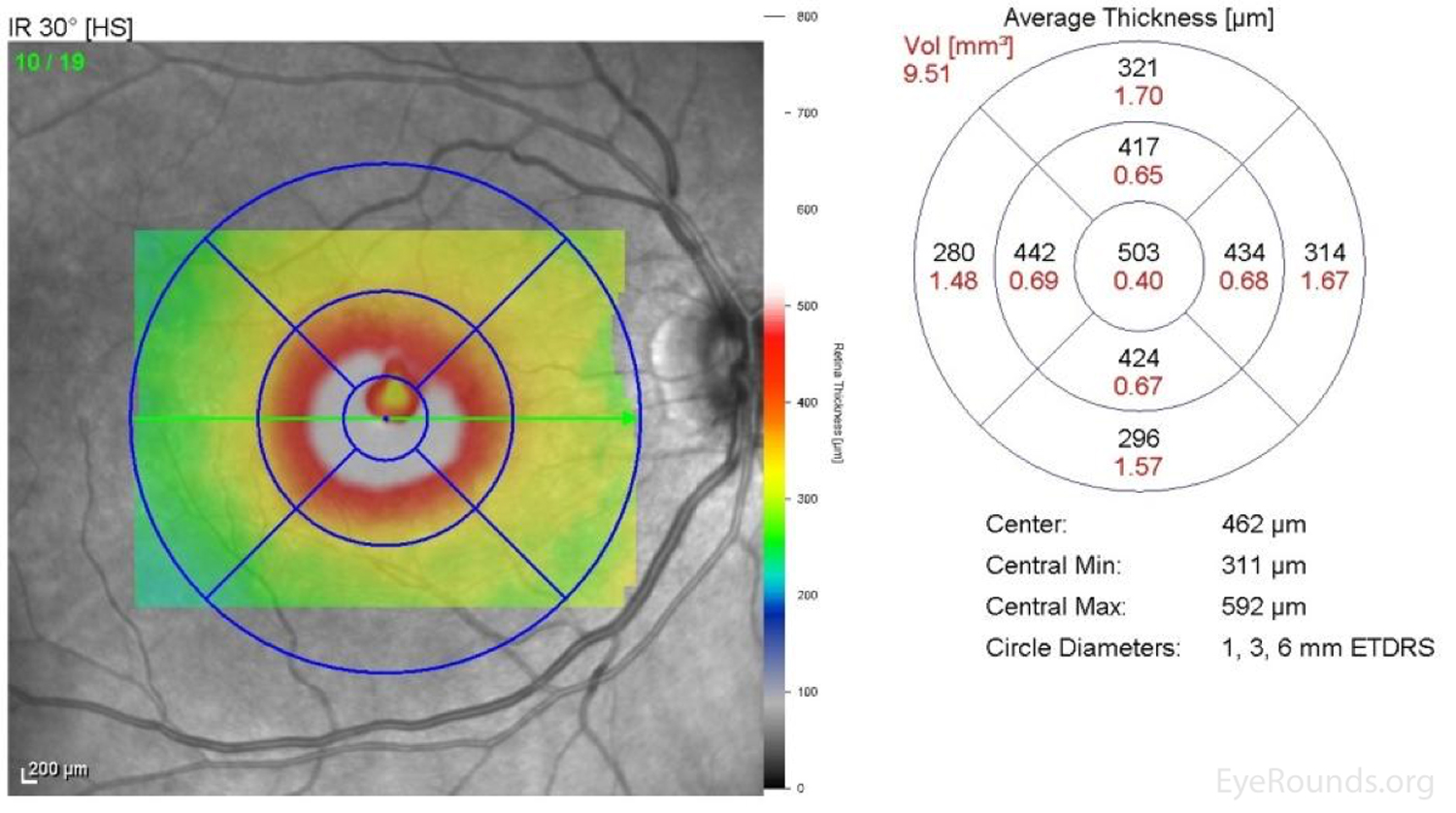 Flashing, blind spots and retinal dots