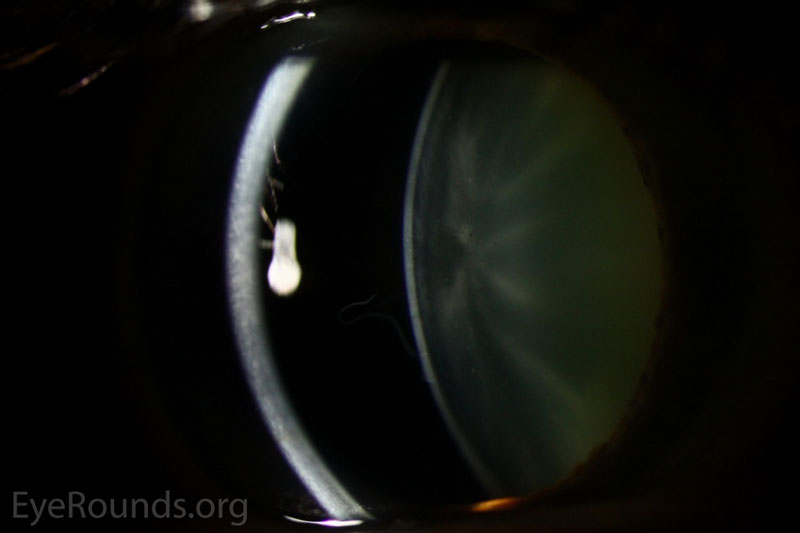 Slitlampfoto OD met spleetbundel die de vrijzwevende flap van lenskapsel schisis doorlaat en omlijnt.