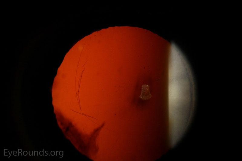 Slitlampsfoto OD med retrobelysning som tydligt beskriver det cirkulära området av schisis med rynkor i den delaminerade fritt flytande klaffen.