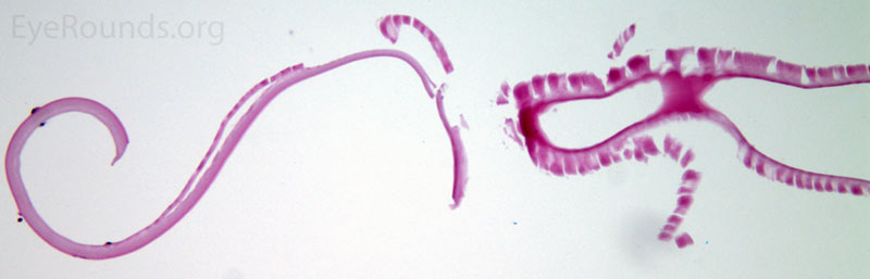 Dos imágenes de la cápsula anterior del cristalino OS (tinción HE en la imagen superior y tinción PAS en la inferior). Ambas tinciones demuestran claramente la delaminación de la cápsula anterior del cristalino con el punto de fijación del colgajo y la ruptura de la porción anterior delaminada.