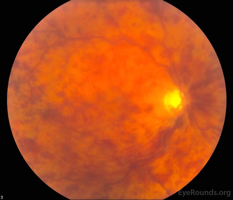 Neovascular glaucoma case link