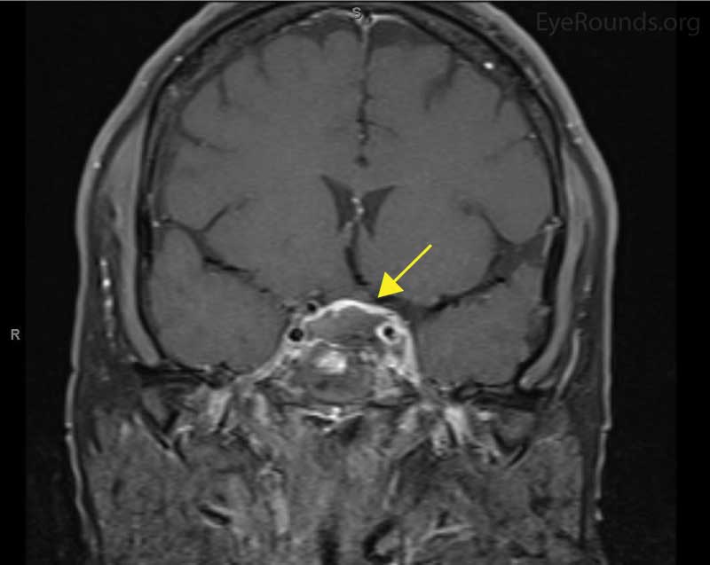 Magnetic resonance imaging of the brain. Left: Coronal image of a suprasellar lesion (arrow) with adjacent spread into the left cavernous sinus. Areas of suspected hemorrhage and necrosis are seen.
