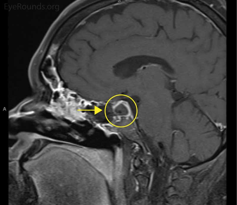 Magnetic resonance imaging of the brain. Right: Sagittal view showing the characteristic pituitary ring sign (arrow), which is suspicious for pituitary apoplexy.