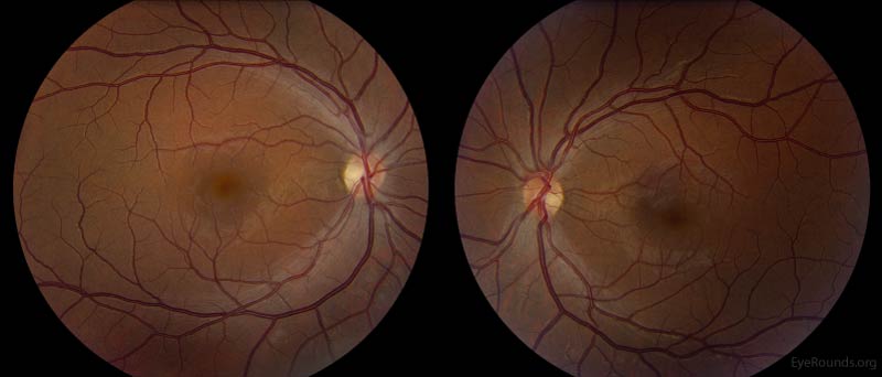Color Fundus Photography, OU. Both optic nerves had temporal pallor. There was a normal macular sheen with faint RPE changes OU.
