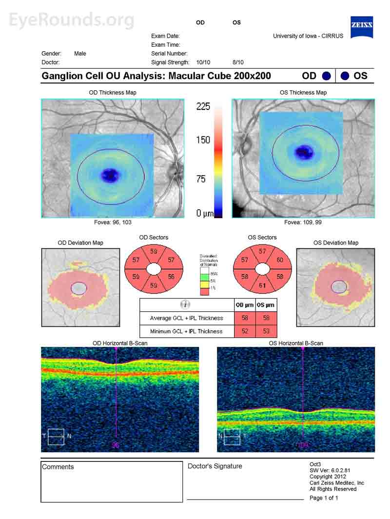 Optical Coherence Tomography (OCT) of the Macula. OU: Diffuse thinning of ganglion cell layer OU.