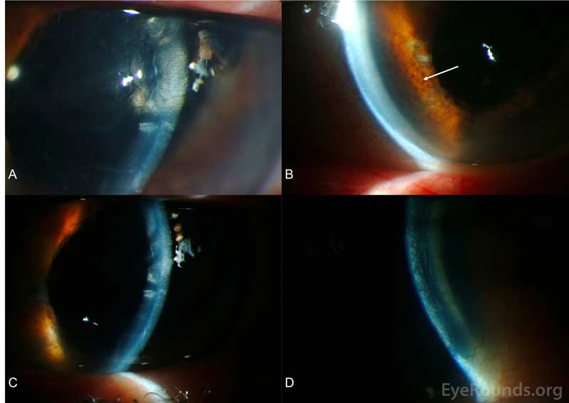 Slit lamp photography, OS. A. The patient had a "beaten metal" appearance of the corneal endothelium, which is classically seen in ICE syndromes. B. Consistent with Cogan-Reese syndrome, there were multiple fine nodules (arrow) distributed over the inferior 180 degrees of the iris. C. There were prominent descemet's folds with diffuse epitheliopathy. D. There was 2+ stromal edema with multiple bullae and 3+ microcystic edema throughout cornea. The patient had further corneal decompensation and underwent descemet stripping automated endothelial keratoplasty 1 month after these photos were taken. 