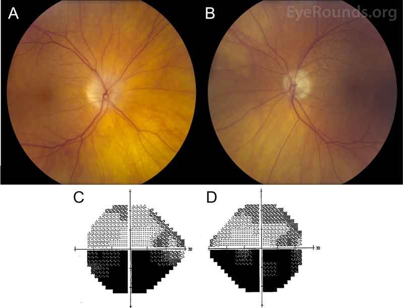 Color fundus photography and Humphrey visual field (HVF) testing, both eyes: A) Right eye has peripapillary atrophy with notable superior hyperemic optic nerve edema and small macular drusen. B) Left eye had peripapillary atrophy, superior optic nerve pallor with trace edema, and small macular drusen. C) HVF testing of the left eye shows a stable inferior altitudinal defect. D) HVF testing of the right eye demonstrates superior arcuate defect extending to blind spot as well as a new inferior altitudinal defect.