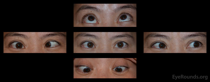 External photographs in primary position and several cardinal gazes. The patient had a large incomitant esotropia that increased on rightward gaze with an associated severe abduction deficit OD. There was a small adduction deficit OD. Supraduction, infraduction OD were full. There were no motility deficits OS. There was no proptosis, ptosis, lid retraction, or periorbital edema of either eye. 