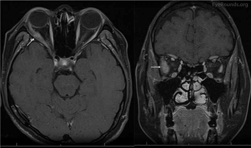 Magnetic resonance imaging (MRI) of the brain and orbits with contrast. Axial (left) and coronal (right) MR imaging showed significant non-uniform enlargement of the right lateral rectus muscle belly (white arrows) without enlargement of other extraocular muscle bellies or the lacrimal glands. There was no lesion along the course of the right sixth nerve. There was absence of sinus disease, retro-orbital mass, or enlargement of the lacrimal gland. 