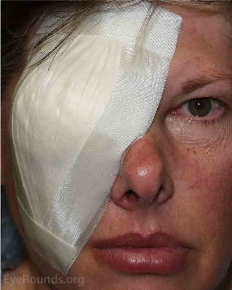 Example of the patch placed over the eye immediately after the eye removal surgery. 
