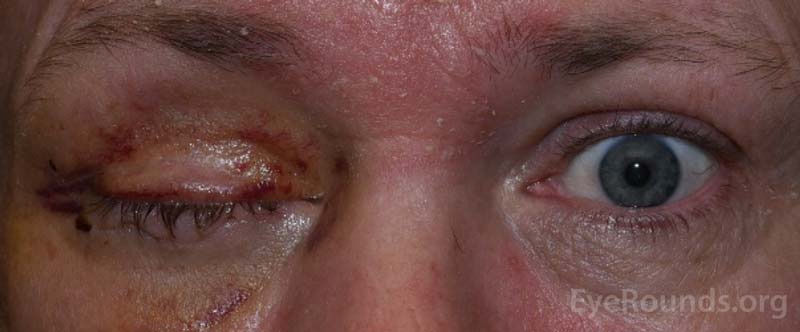 Example of the bruising and swelling that is typical after eye removal surgery. Note that patients often have their eyelid temporarily sewn shut to promote healing.