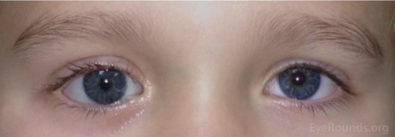 Examples of patients wearing prosthetic eyes.