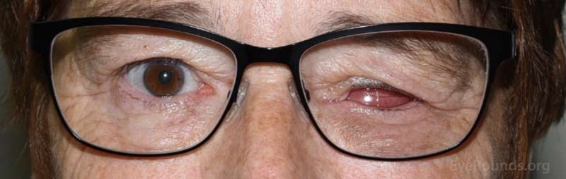 Example of patient wearing protective polycarbonate lenses. 