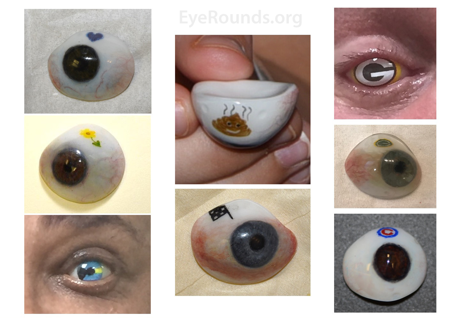 ocular prosthetic