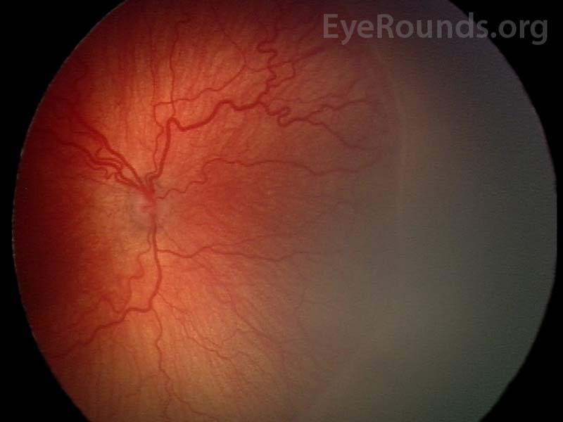 Fundus photo of plus disease showing tortuous arteries and dilated veins.