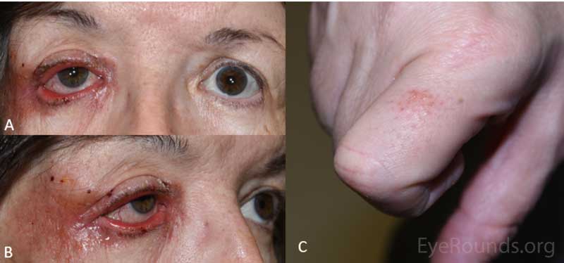 External photograph demonstrating rash of the right eyelid and periocular region (A and B) as well as the right proximal index finger (C)