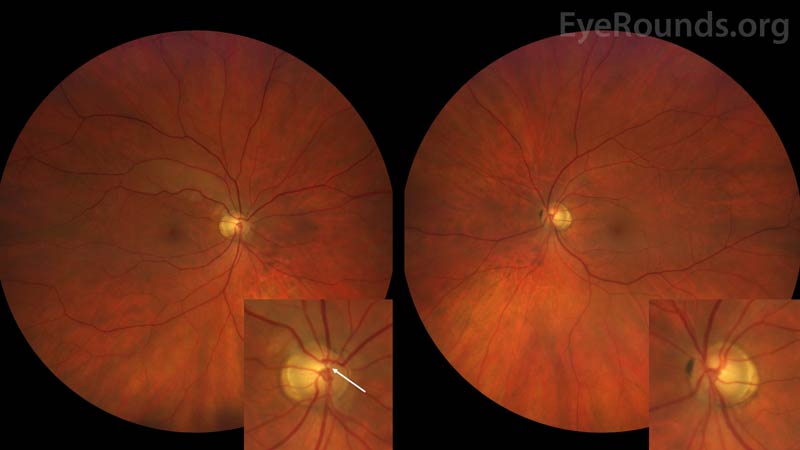 Color fundus photography of the right eye demonstrates a large cup-to-disc ratio of 0.6 with associated peripapillary atrophy and a Hollenhorst plaque lodged within a branch point of the superior arcade
