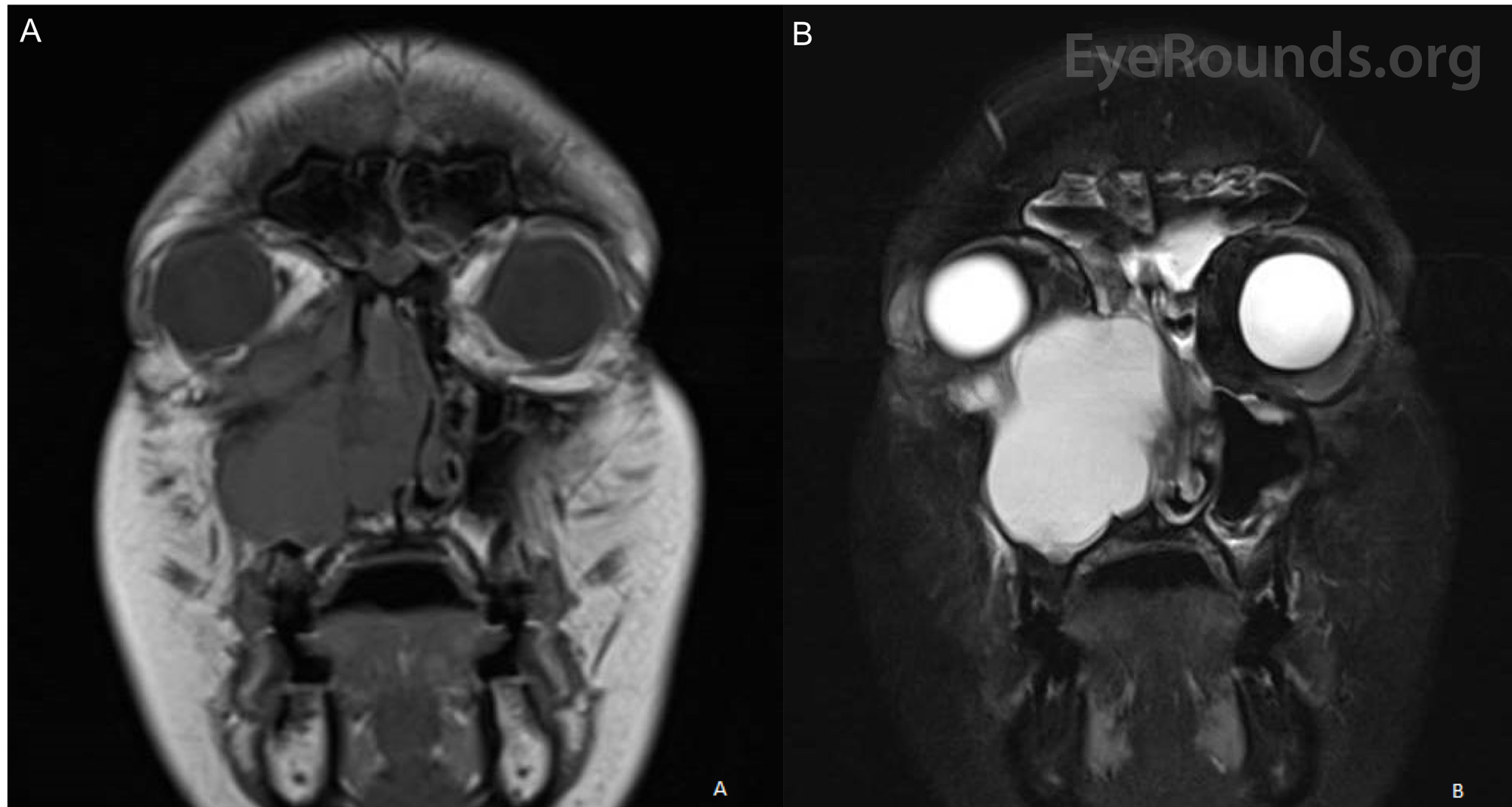 Maxillary Sinus Polyp Mri