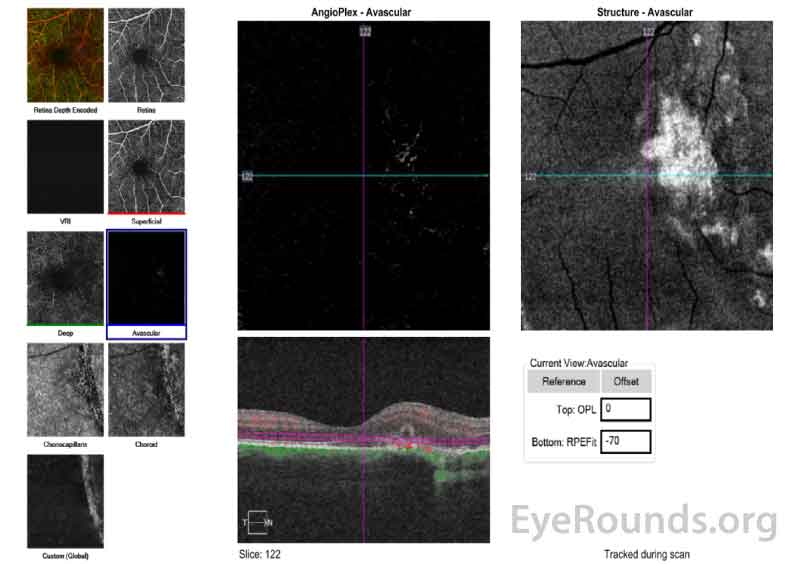 Optical Coherence Tomography Angiography (OCT-A) of the right eye showing the avascular layer of the retina