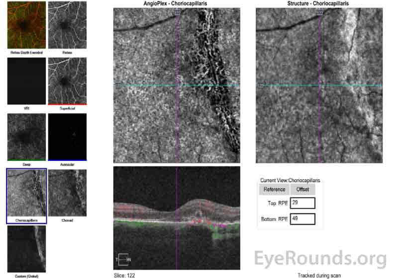 Optical Coherence Tomography Angiography (OCT-A) of the right eye shows the choriocapillaris layer