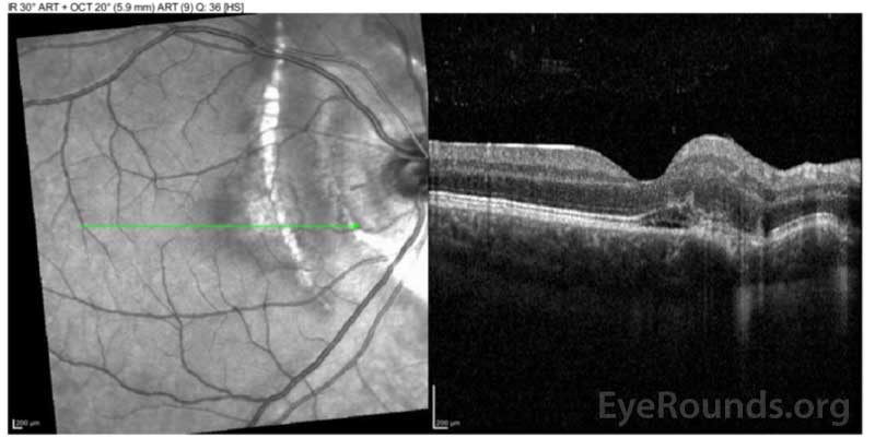 Optical coherence tomography (OCT) of the right eye with subretinal hyperreflective material