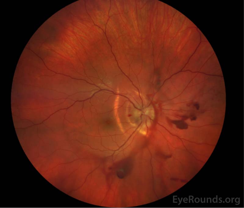 Color fundus photograph of the right eye showing vitreous hemorrhage over the optic nerve and more dense vitreous hemorrhage layering inferiorly.