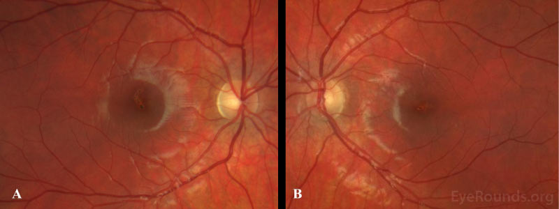 Color fundus photograph of the right macula.