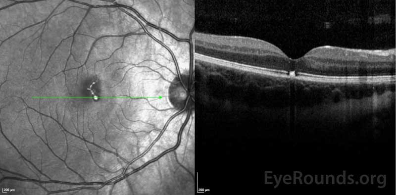 OCT of the right macula showing disruption of the ellipsoid zone with RPE loss involving the umbo with a collection of focal hyperreflective material.