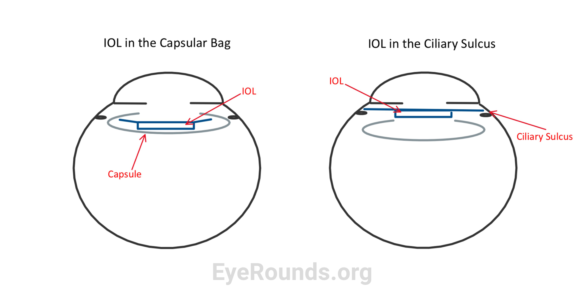 Pressurized capsular bag of intumescent white cataract can be challenging