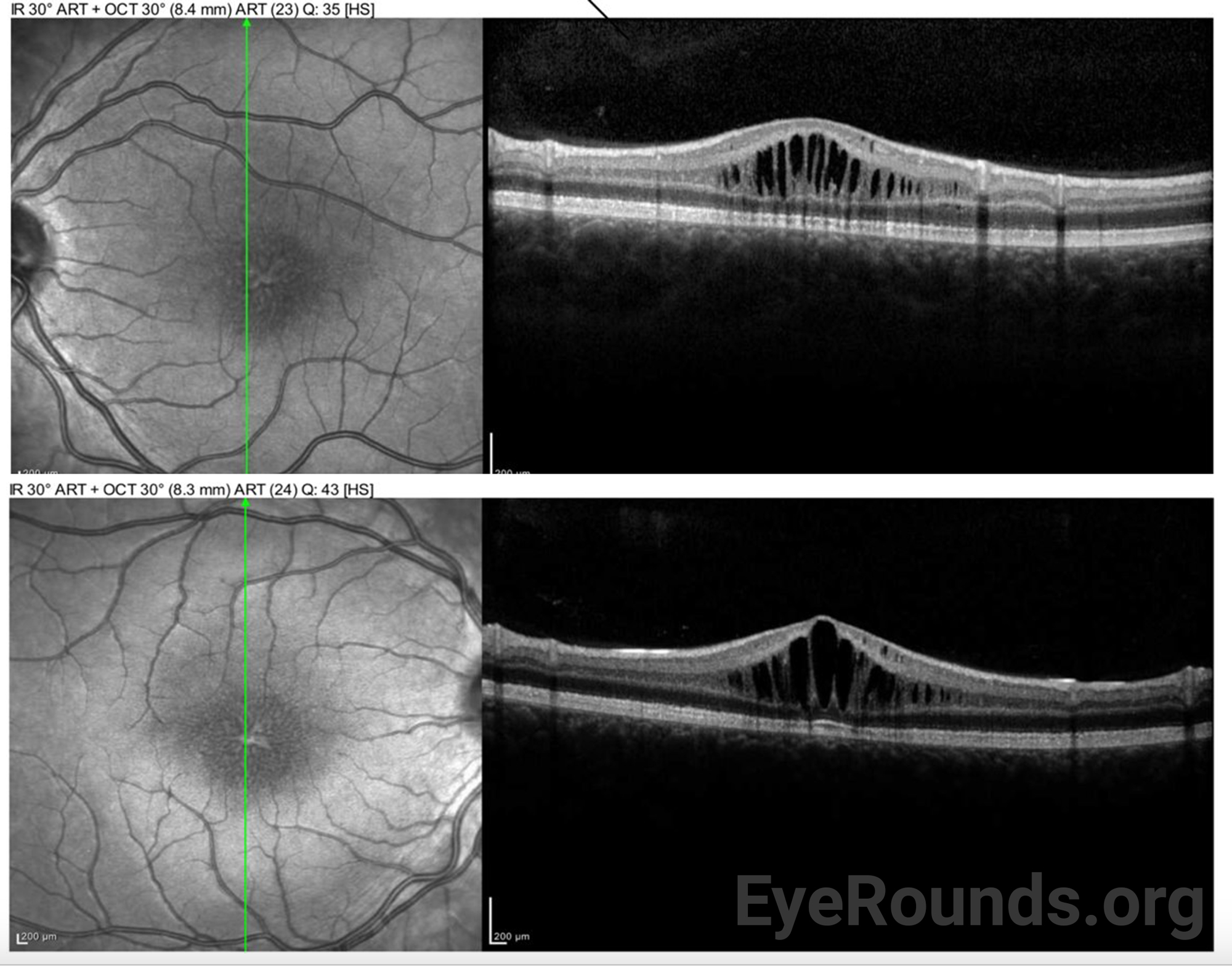 Diagnosis And Management Of Juvenile X linked Retinoschisis JXLR 