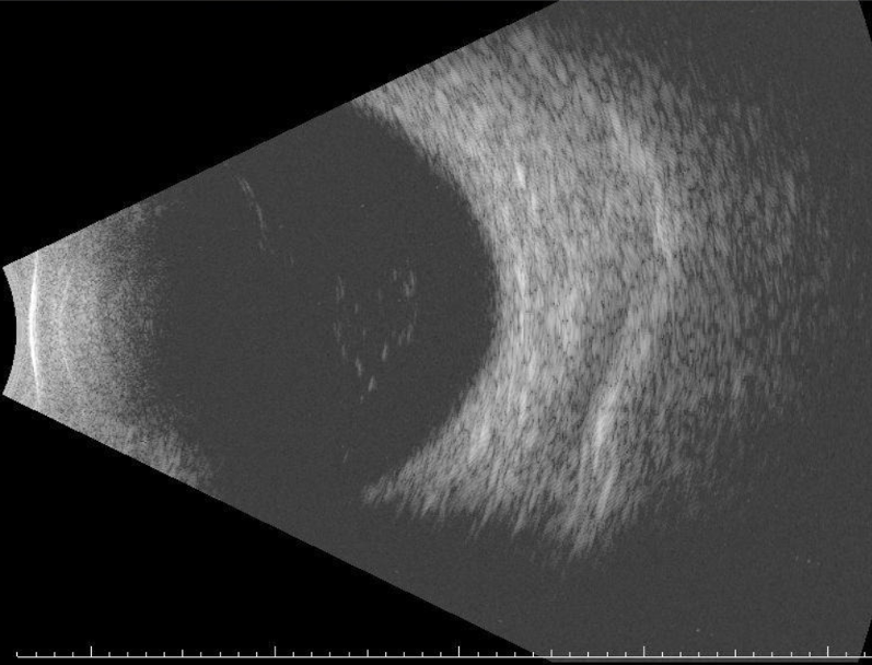 Ophthalmic ultrasound of left eye on our initial evaluation did not suggest endophthalmitis or concurrent retinal detachment. 
