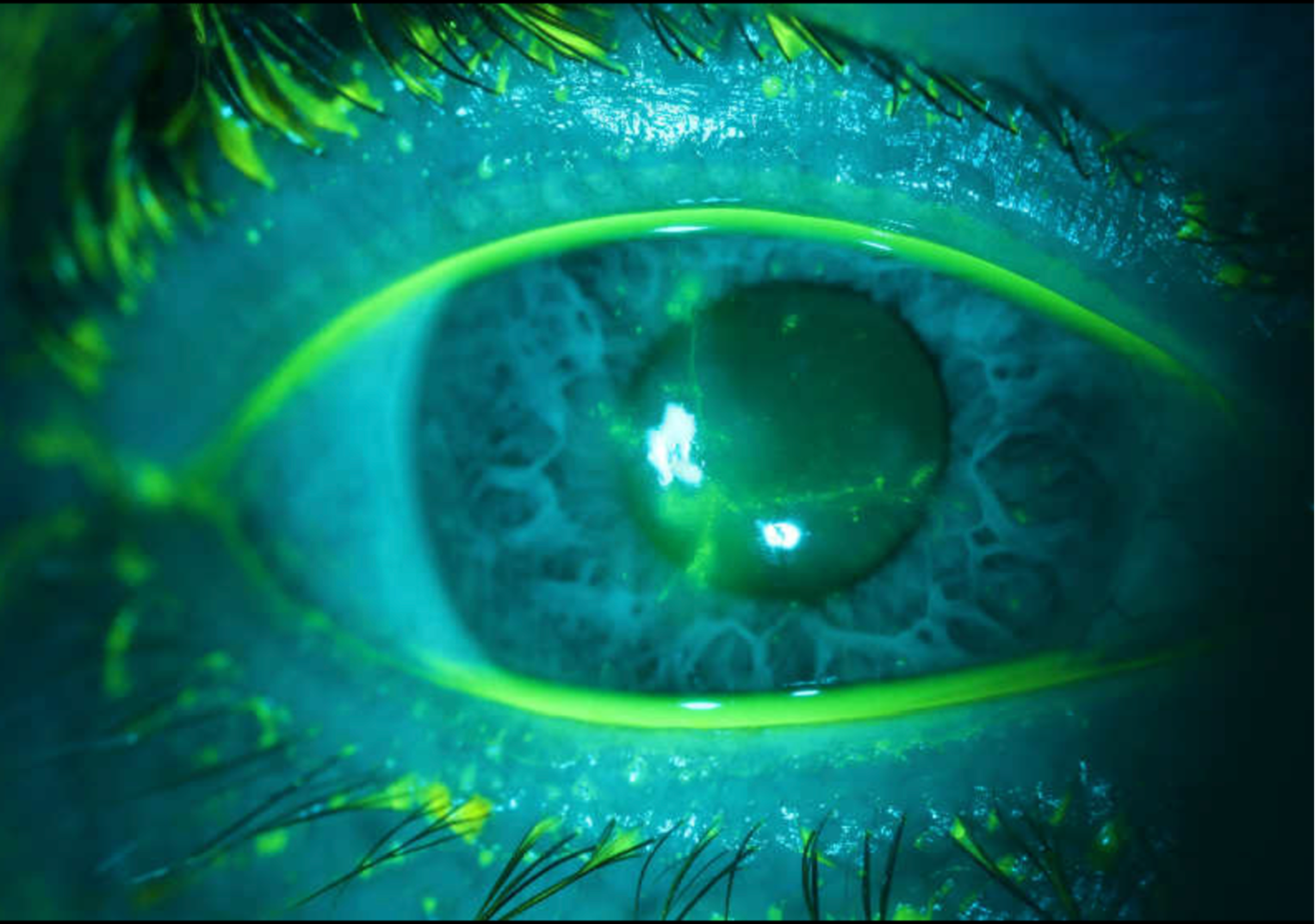 Right eye with fluorescein demonstrating dendritic lesions with terminal bulbs on initial presentation.
