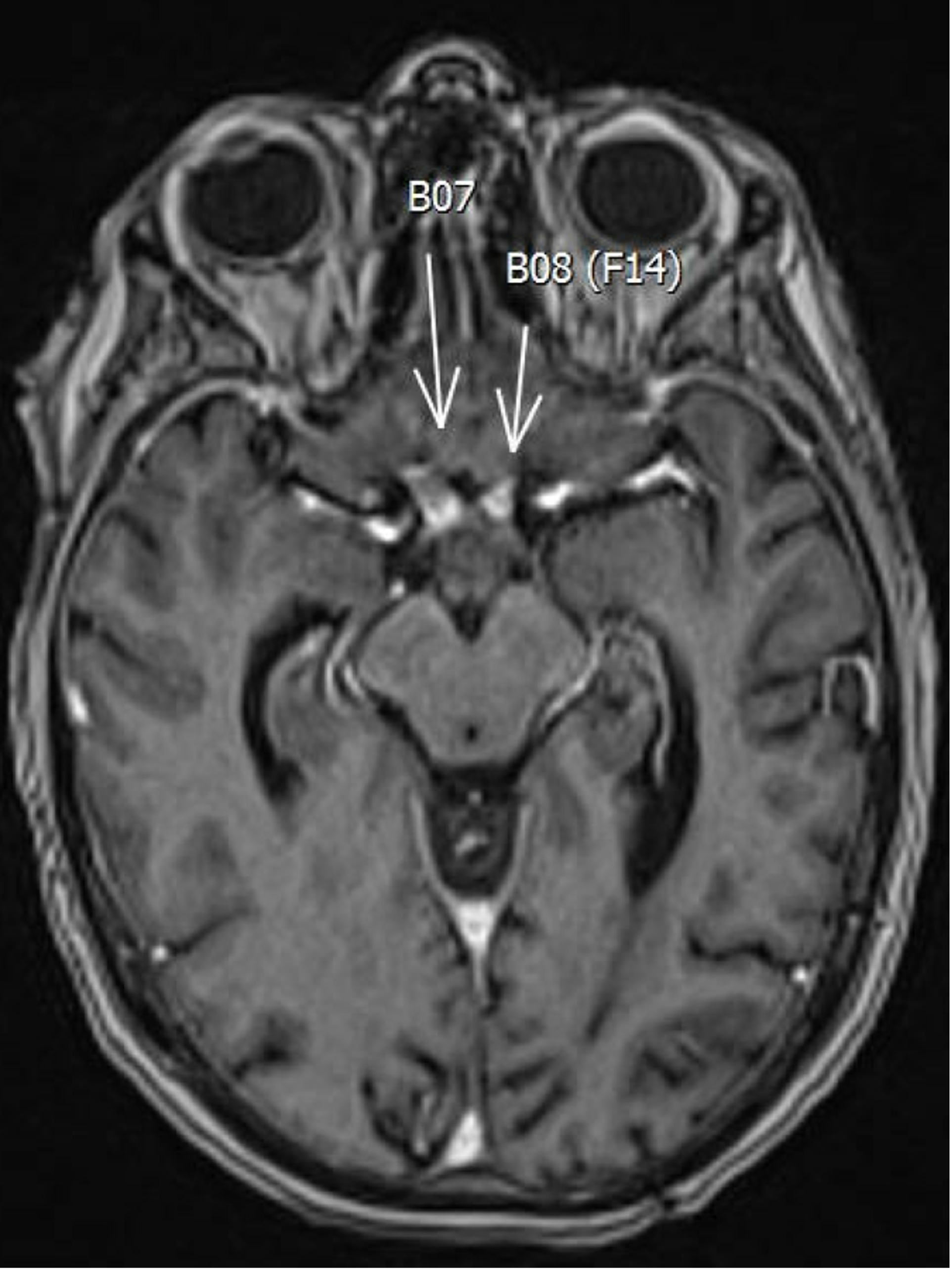 Axial post-gadolinium T1-weighted MRI (left) showed bilateral enhancement within the optic nerves anterior to the chiasm (arrows). Axial T2-FLAIR sequence showed an abnormality likely related to edema secondary to the enhancing foci (right). The findings were consistent with radiation optic neuropathy.