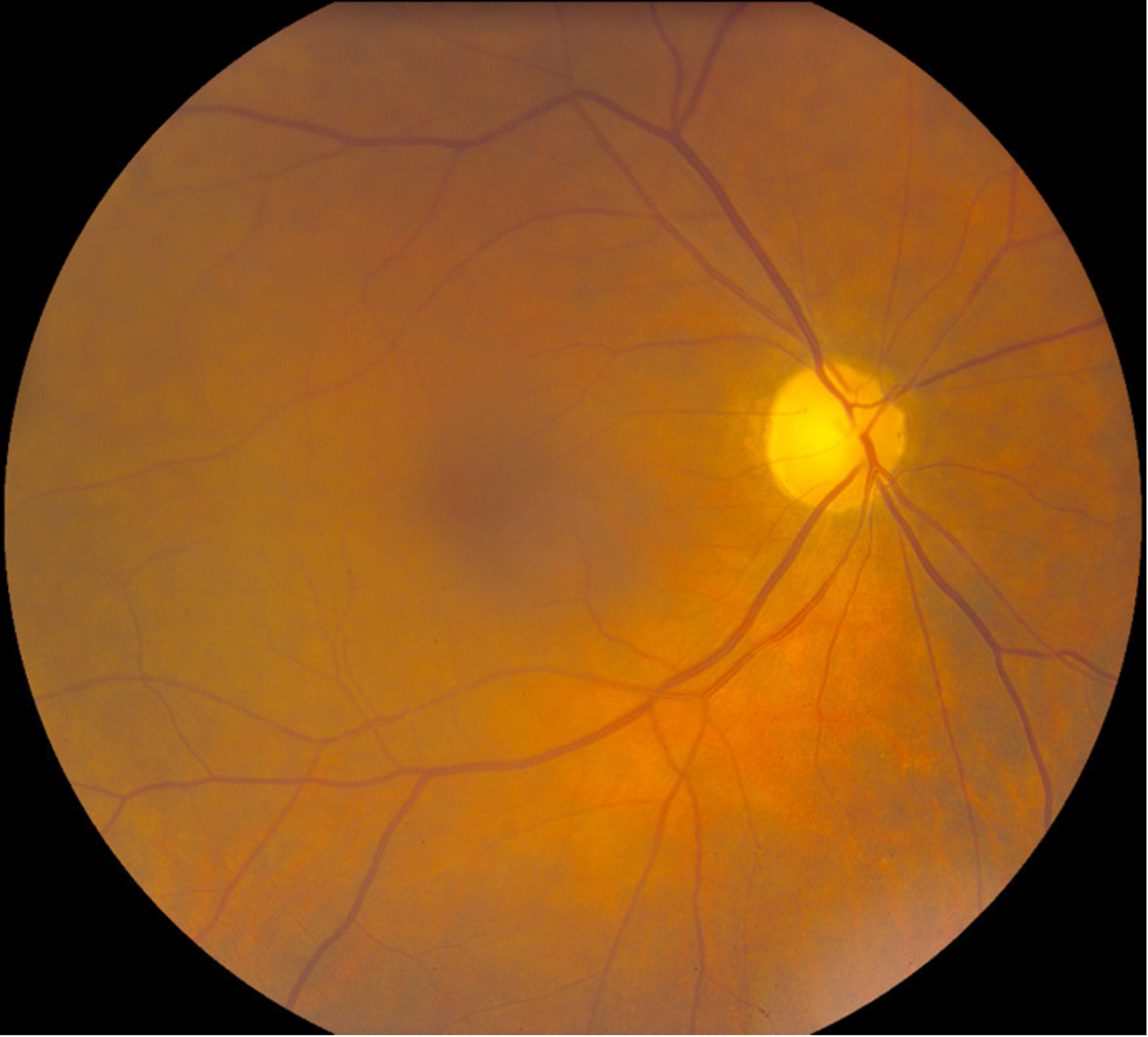 Color fundus photography of OD (left) and OS (right) showing bilateral optic nerve pallor with mild arteriolar narrowing.